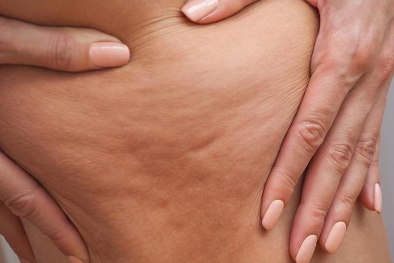 женщина схватилась за бедро с целлюлитом