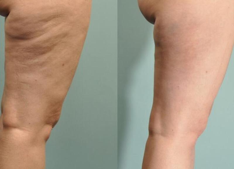 10 дней после лечения целлюлазой