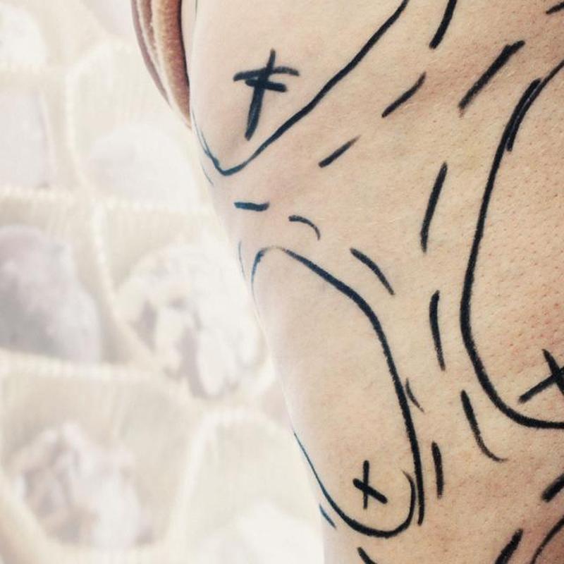 Бедро женщины отмечено для липосакции