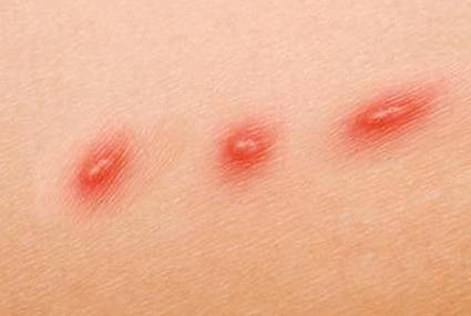 Лихорадка от кошачьих царапин