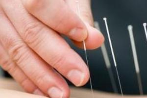 Фото иглоукалывания крупным планом