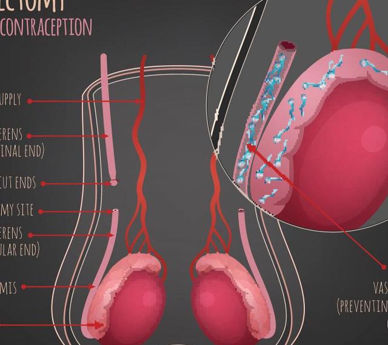 Иллюстрация вазэктомии