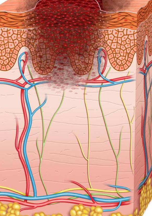 меланома 1 стадия