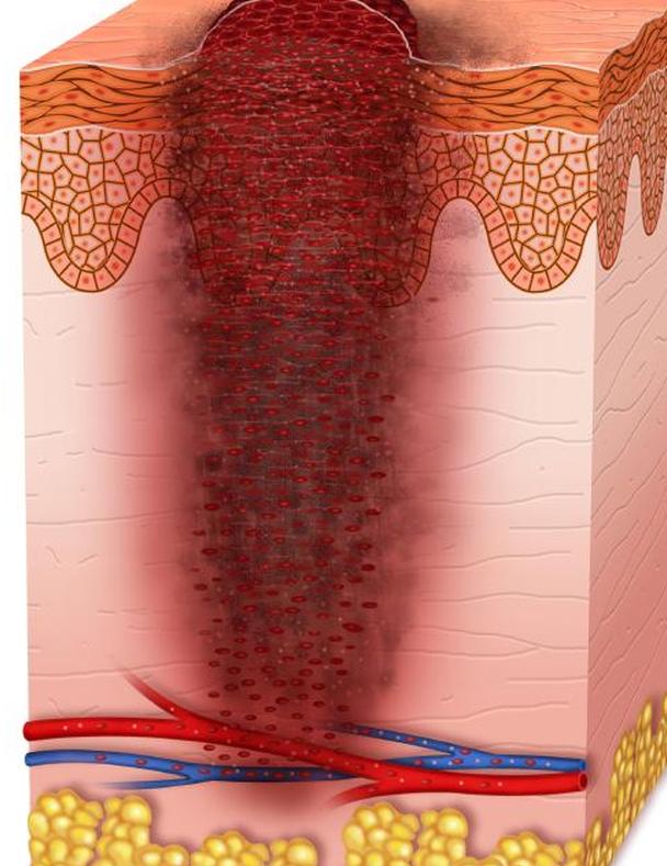 меланома 3 стадия