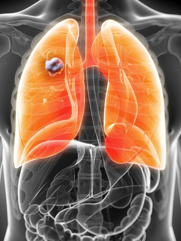 Меланома 4 стадии