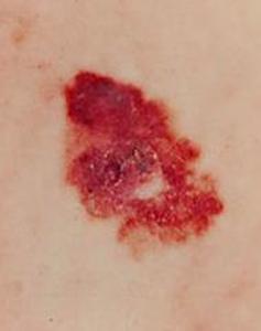 меланома кожи 2 стадия