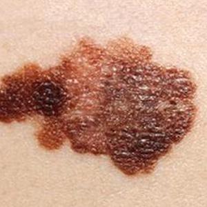 меланома 3 стадии на коже