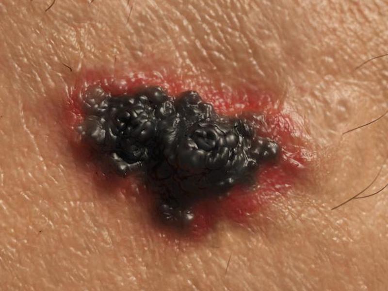 меланома кожи 4 стадии