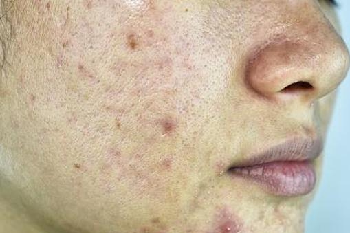 лицо женщины с кистозными угрями
