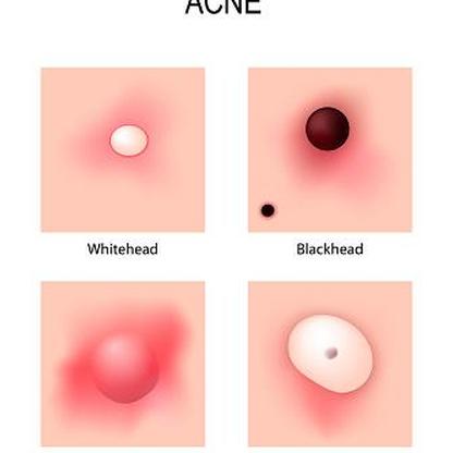 виды прыщей