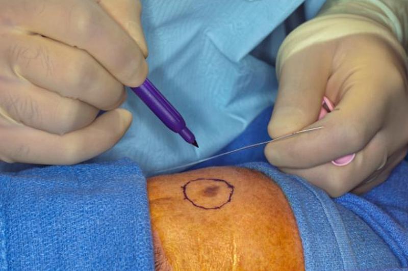 лечение меланомы широким локальным разрезом