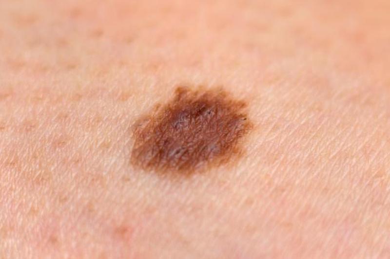 микроинвазивная меланома