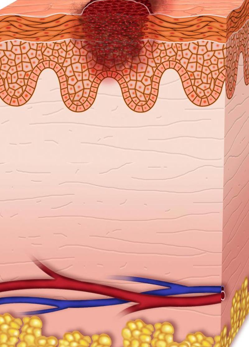 меланома 0 стадия