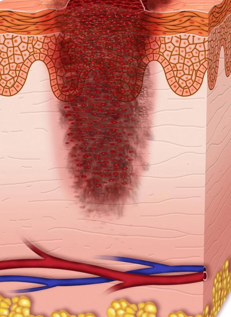 меланома 2 стадия